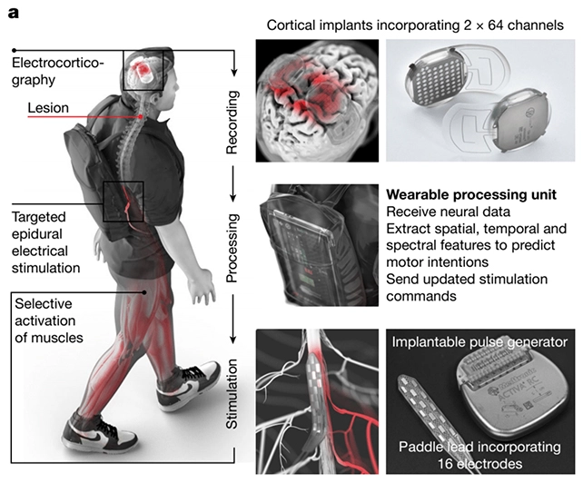 AI and rehab